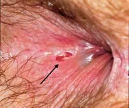 Anal lesions in crohns Girls getting fucked by big cock